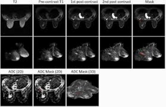 Differentiating malignant from benign breast masses {faces}