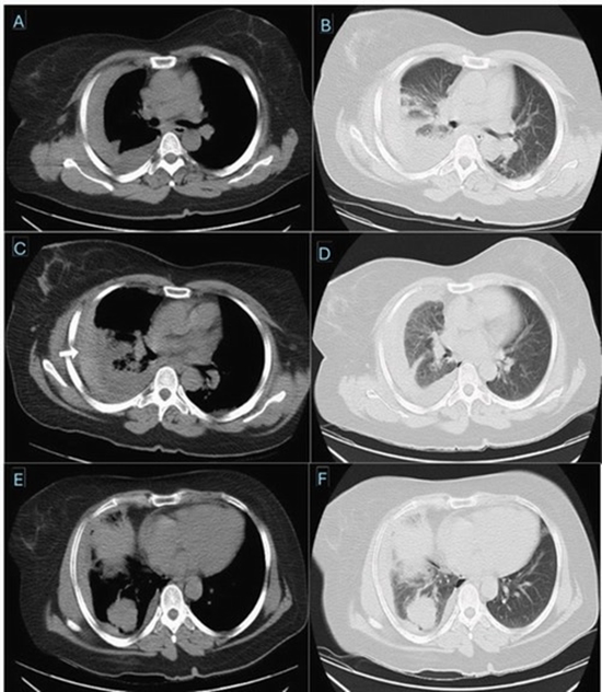 Massive hemothorax following CTguided lung biopsy {faces}