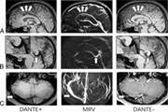 MR black-blood thrombus imaging in cerebral venous thrombosis {faces}