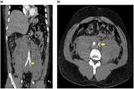 Fatal Spontaneous Retroperitoneal Hematoma Following Physical Exertion {faces}