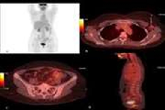 No Restriction on DWI and Low Uptake in PET CT in Breast Lobular Cancer {faces}
