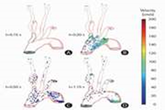 Patient-Specific Hemodynamic Simulation for Predicting Cardiac Stroke   {faces}