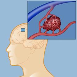 آمبولیزاسیون avm مغزی