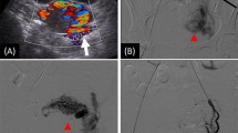 Fertility outcomes after uterine artery embolization for symptomatic uterine arteriovenous malformations: a single-center retrospective study in 33 women