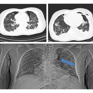 Spontaneous Loculated Pneumomediastinum in a COVID-19-Infected Patient