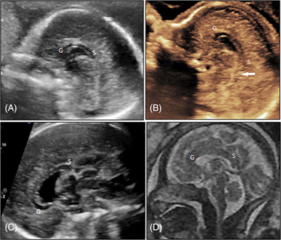 Fetal corpus callosum abnormalities: Ultrasound and magnetic resonance imaging role