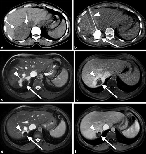 Computed Tomography Fluoroscopy-Guided Percutaneous Transhepatic Bleomycin/Ethiodized Oil Sclerotherapy for Symptomatic Giant Hepatic Hemangioma