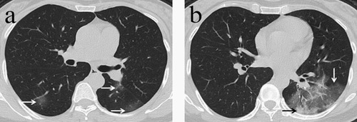 Evaluation of Follow-Up CT Scans in Patients with Severe Initial Pulmonary Involvement by COVID-19