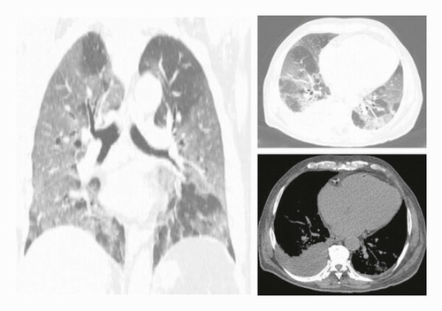 Chest CT scan features to predict COVID-19 patients' outcome and survival