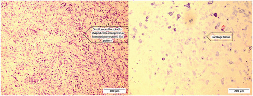 Expanded intravenous mesenchymal chondrosarcoma with clinical presentation of deep vein thrombosis