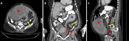 Sigmoid volvulus in a postmenopausal woman with ovarian cyst torsion: A rare case report with review of literature