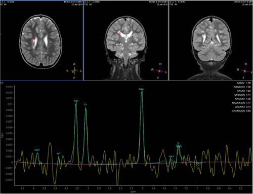 Impact of stem cell therapy on brain metabolic profile in cerebral palsy assessed by magnetic resonance spectroscopy in a randomized clinical trial