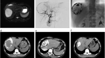 Commentary on Thermal Ablation for Giant Hepatic Hemangiomas: A Meta-Analysis with Subgroup Analysis of Microwave and Radiofrequency Ablation Techniques