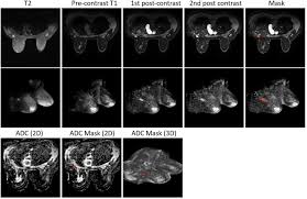 Differentiating malignant from benign breast masses: a multiparametric magnetic resonance imaging (MRI)-based radiomics approach with machine learning