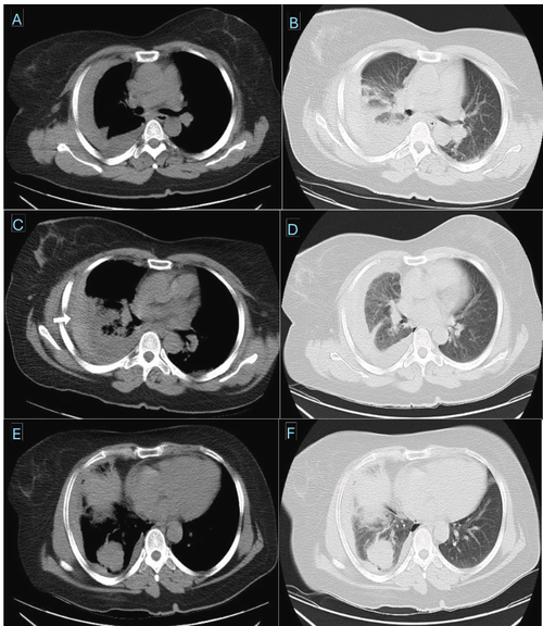 Massive hemothorax following CT-guided lung biopsy: A rare iatrogenic complication managed conservatively