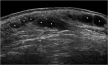 Ultrasonographic evaluation of cosmetic fillers patterns and frequent complications-A literature review