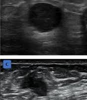 Differences in Ultrasound Characteristics Among Molecular Subtypes of Breast Cancer: A Retrospective Cross-Sectional Analysis