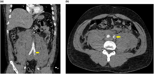 Fatal Spontaneous Retroperitoneal Hematoma Following Intense Physical Exertion in a Young Healthy Male: A Case Report