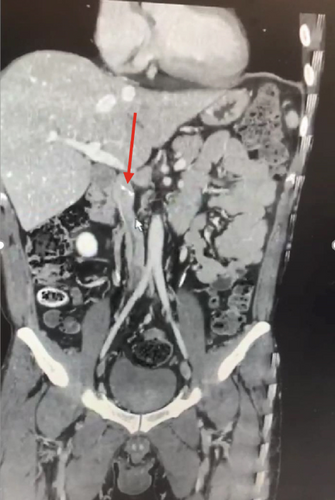 Complicated IVC Filter Placement in a Patient With Venous Abnormality: A Case Report