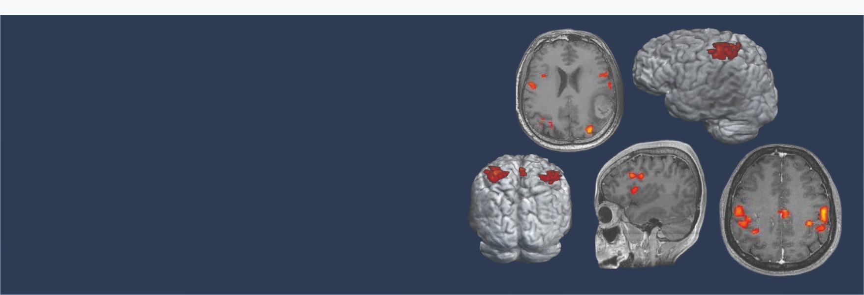 The role of brain imaging in the early diagnosis of Alzheimer's disease