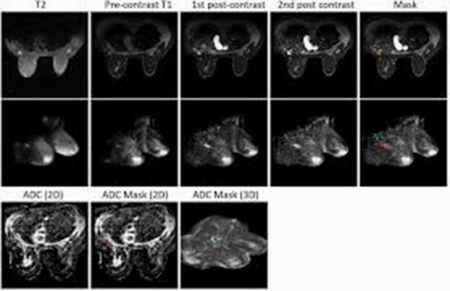 Differentiating malignant from benign breast masses: a multiparametric magnetic resonance imaging (MRI)-based radiomics approach with machine learning