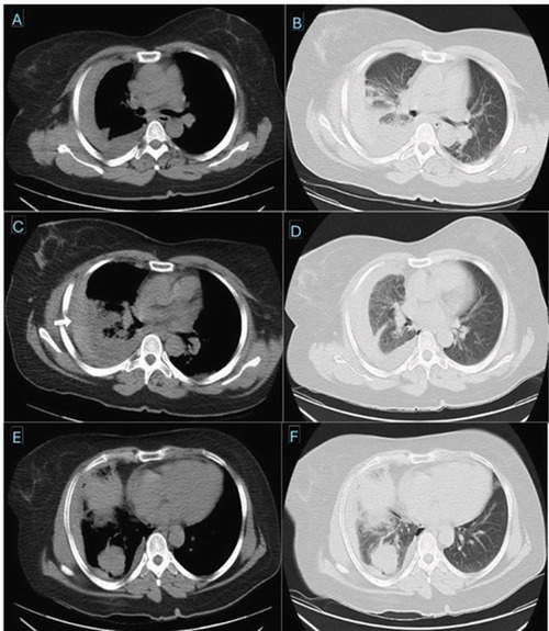 Massive hemothorax following CTguided lung biopsy A rare iatrogenic complication managed conservatively