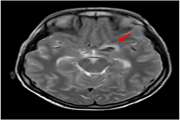 Pediatric intracranial internal carotid artery aneurysm masquerading as meningitis: a case report