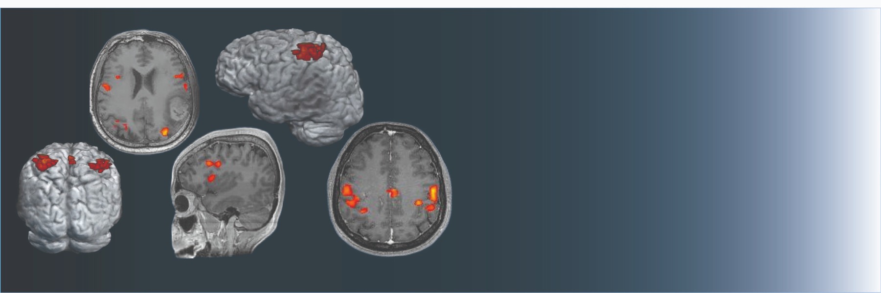 دورُ التَّصويرِ الدِّماغي في التَّشخيصِ المُبَكِّر لِمَرضِ الألزهايمر